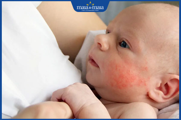 viêm da tiếp xúc trẻ sơ sinh