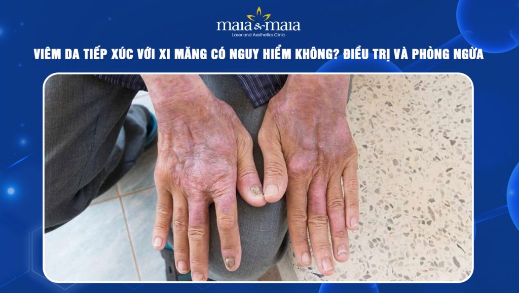 Viêm da tiếp xúc với xi măng