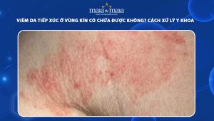 viêm da tiếp xúc vùng kín