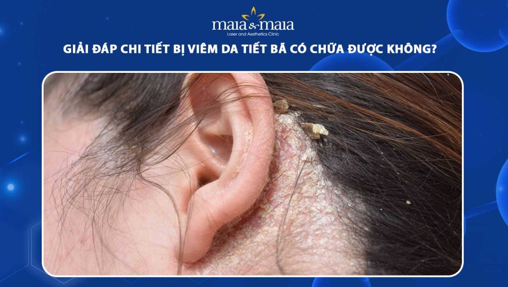 viêm da tiết bã có chữa được không