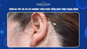 Viêm da tiết bã có lây không