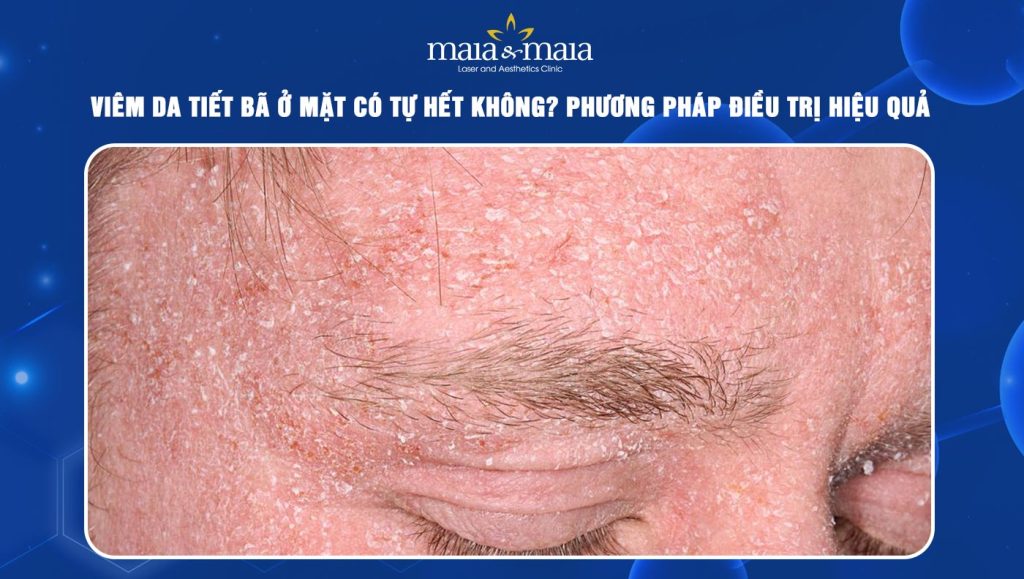 Viêm da tiết bã ở mặt