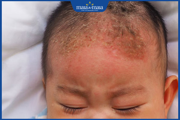 viêm da tiết bã ở trẻ nhỏ