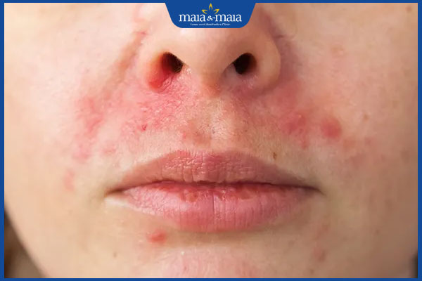 viêm da tiết bã quanh mồm