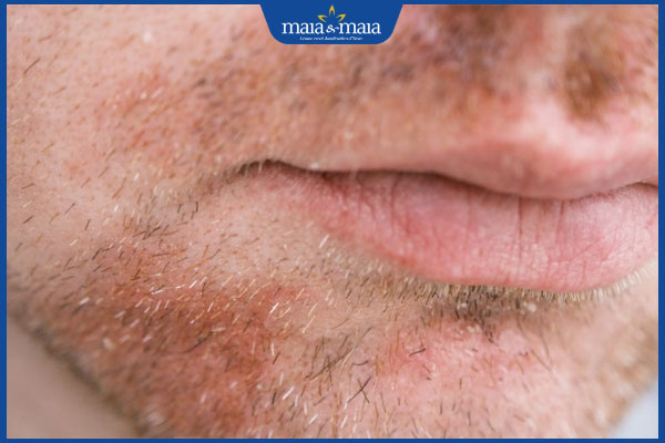 viêm da tiết bã ria mép
