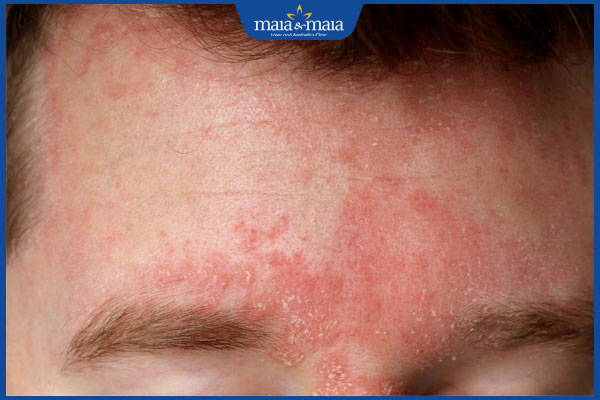 viêm da tiết bã trán