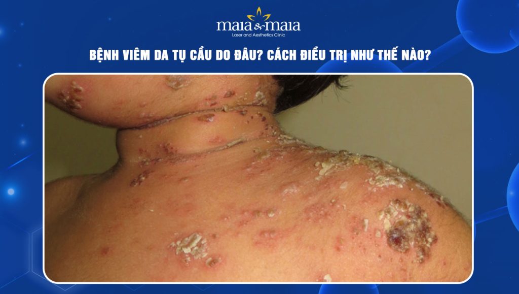 Bệnh viêm da tụ cầu do đâu? Cách điều trị như thế nào? 1 viêm da tụ cầu