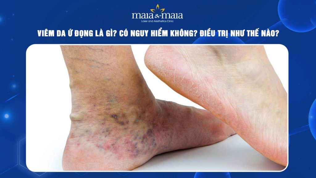 Viêm da ứ đọng