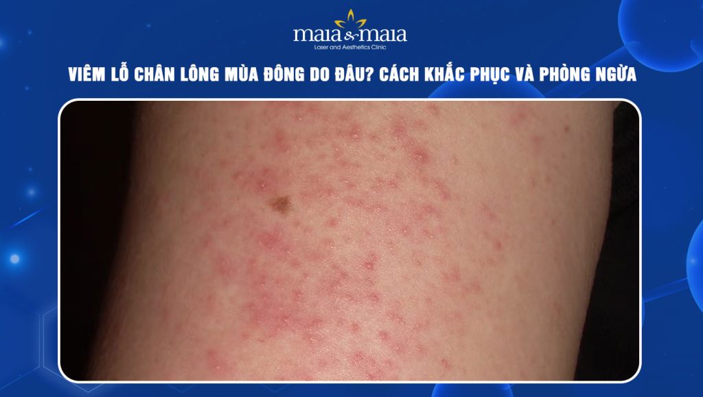 Viêm lỗ chân lông mùa đông
