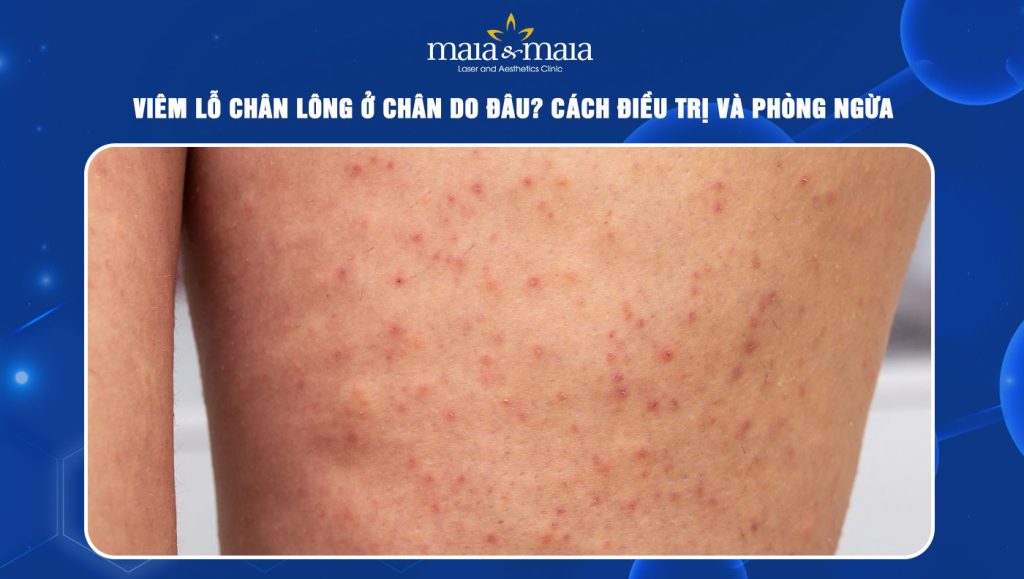 Viêm lỗ chân lông ở chân