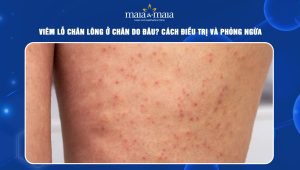Viêm lỗ chân lông ở chân