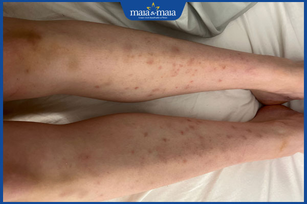 Tổng hợp các loại viêm nang lông phổ biến và cách chẩn đoán chính xác 4 viêm lỗ chân lông ở chân gây thâm sẹo