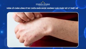 viêm lỗ chân lông ở tay