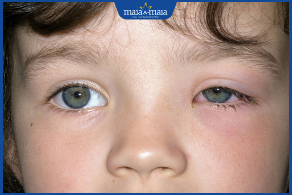 viêm mô tế bào quanh mắt