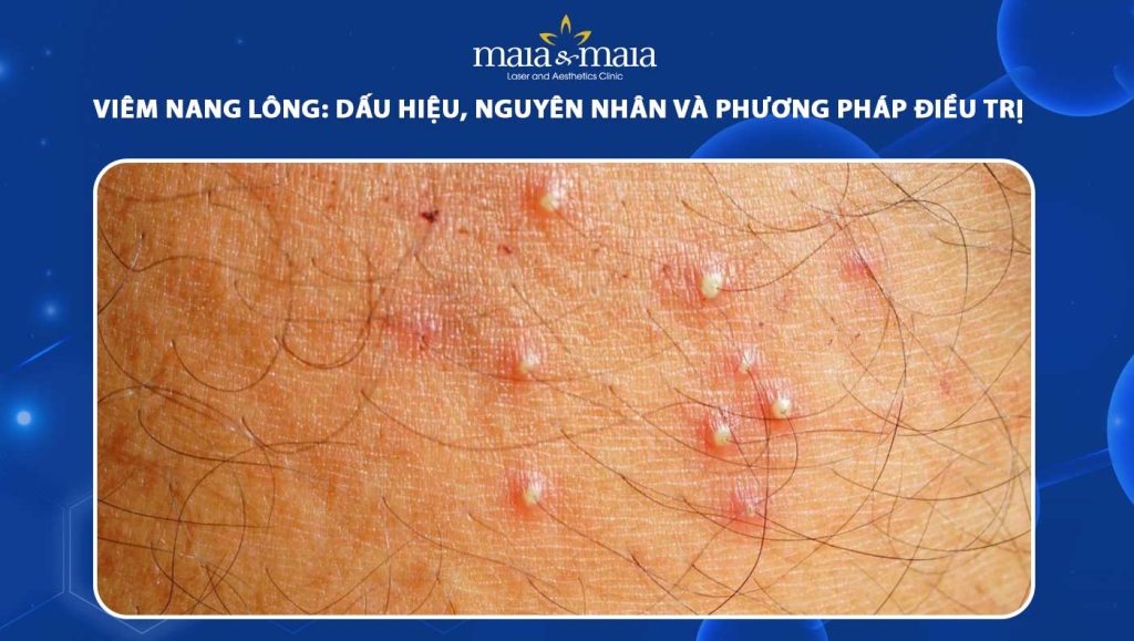 Viêm nang lông: Dấu hiệu, nguyên nhân và cách điều trị 1 viêm nang lông