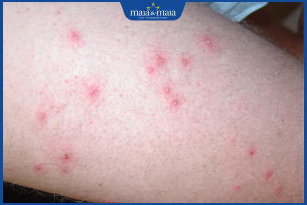 Viêm lỗ chân lông ở chân do đâu? Cách điều trị và phòng ngừa 4 viêm nang lông bắp chân