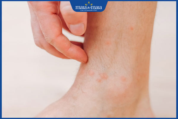 Viêm lỗ chân lông ở chân do đâu? Cách điều trị và phòng ngừa 6 viêm nang lông chân ngứa