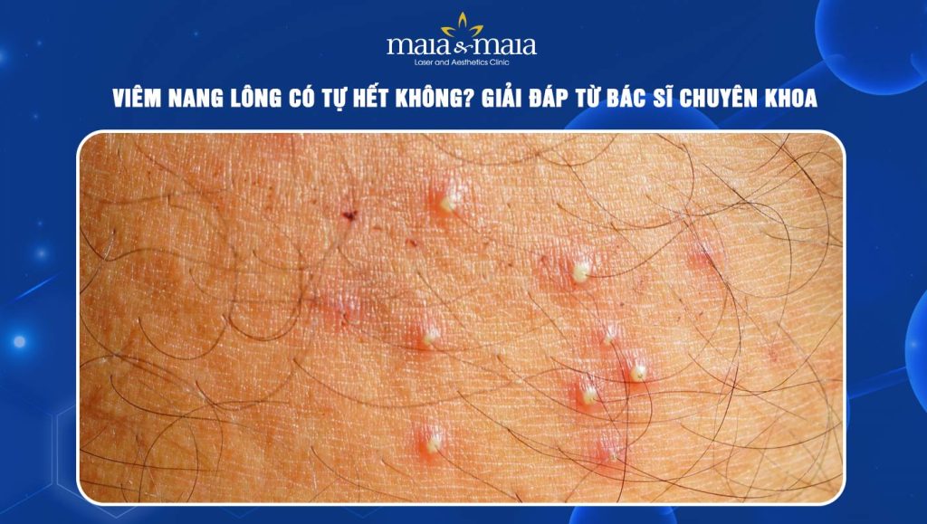 viêm nang lông có tự hết không
