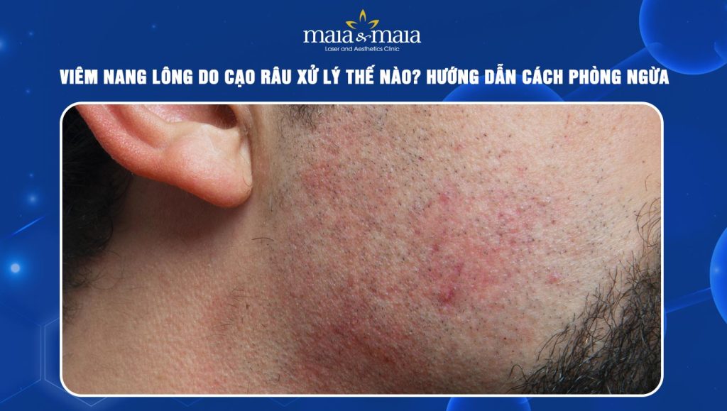 viêm nang lông do cạo râu