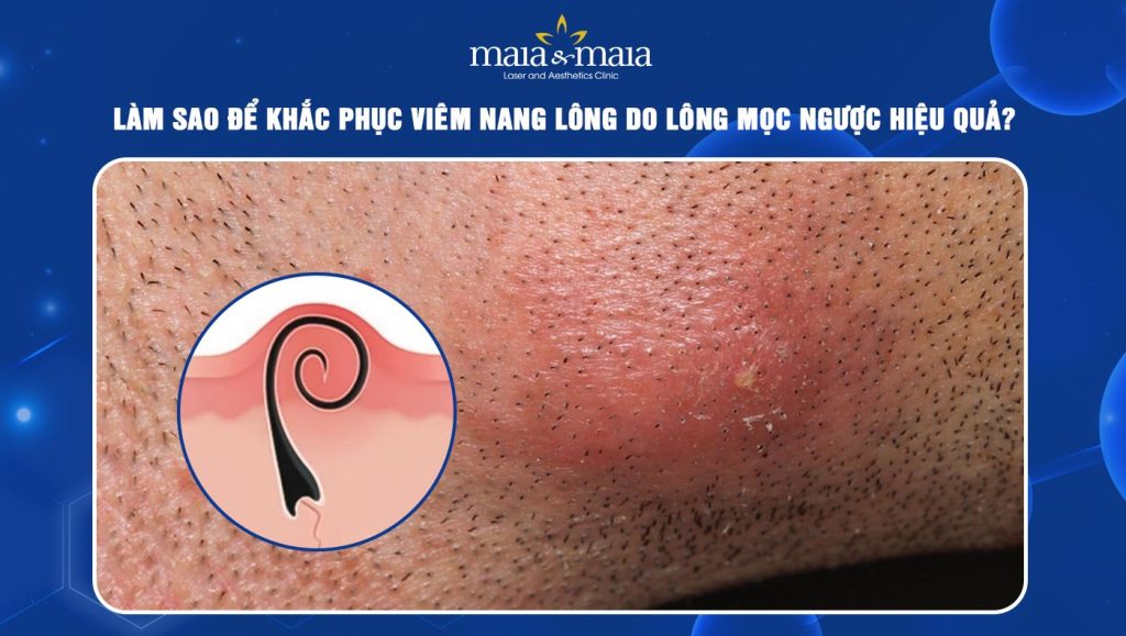 Viêm nang lông do lông mọc ngược