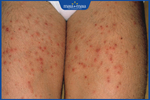 Viêm lỗ chân lông ở chân do đâu? Cách điều trị và phòng ngừa 5 viêm nang lông đùi