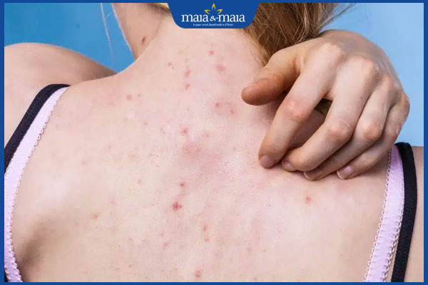 viêm nang lông lưng ngứa