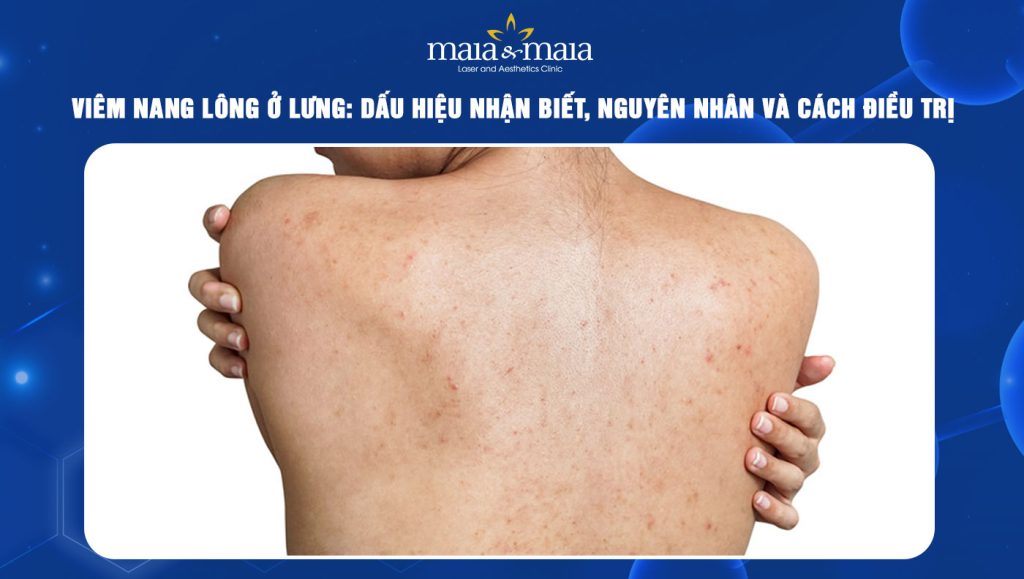 Viêm nang lông ở lưng