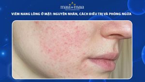 viêm nang lông ở mặt