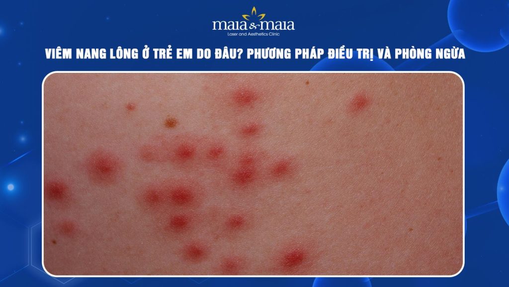 viêm nang lông ở trẻ em