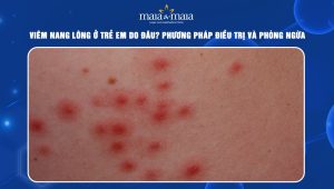 viêm nang lông ở trẻ em