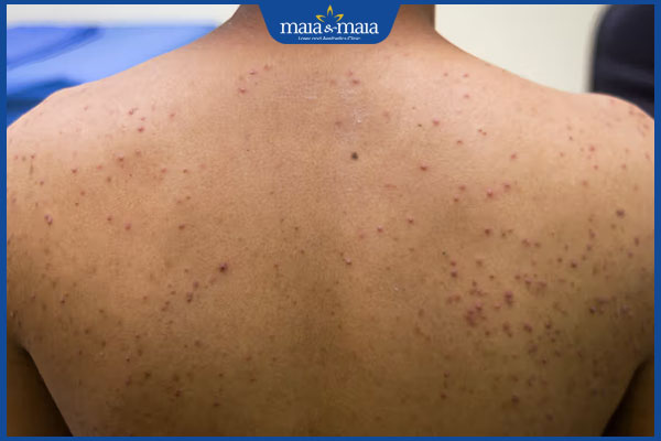 Viêm nang lông: Dấu hiệu, nguyên nhân và cách điều trị 6 viêm nang lông ở vùng lưng