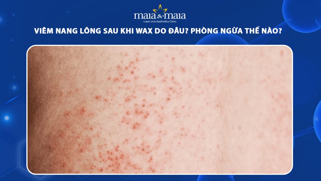 viêm nang lông sau khi wax