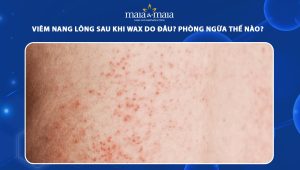 viêm nang lông sau khi wax