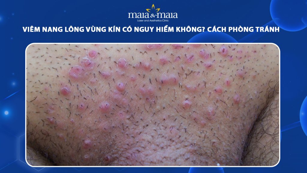 viêm nang lông vùng kín