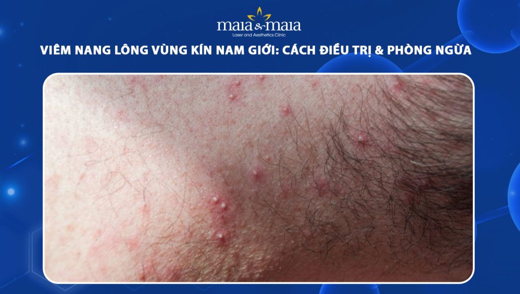 viêm nang lông vùng kín ở nam giới