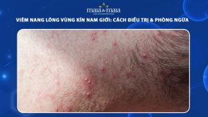 viêm nang lông vùng kín ở nam giới