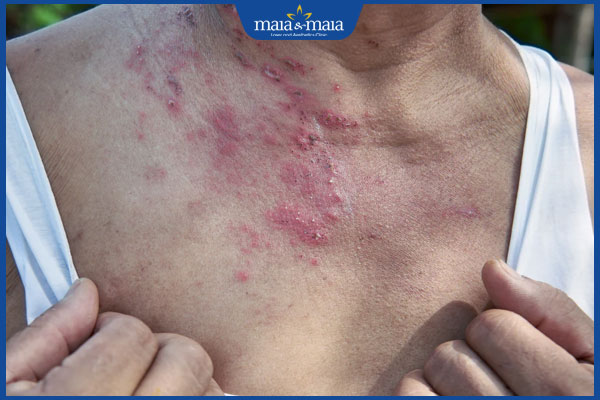 Zona thần kinh liên sườn: Nguyên nhân và hướng điều trị 7 vùng zona ở cổ