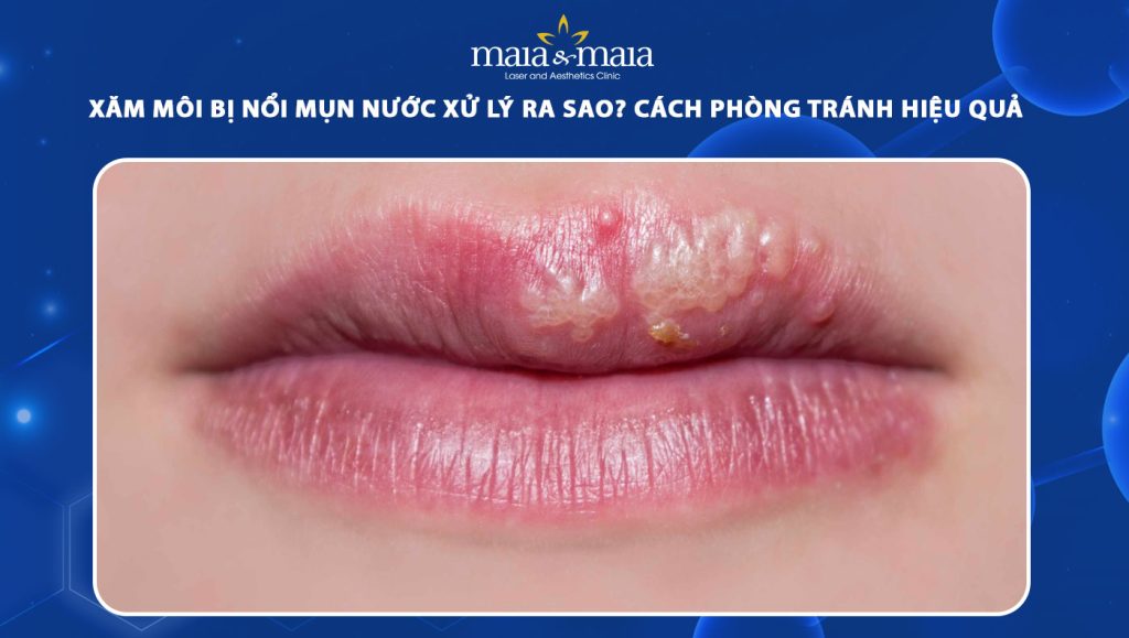 Xăm môi bị nổi mụn nước xử lý ra sao? Cách phòng tránh 1 xăm môi bị nổi mụn nước