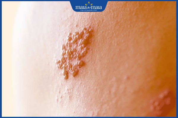 Zona có nguy hiểm không? Biến chứng tiềm ẩn cần chú ý 2 zona phát ban