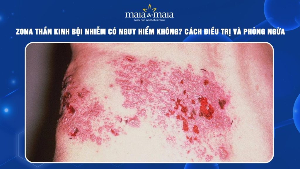 Zona thần kinh bội nhiễm có nguy hiểm không? Cách điều trị 1 zona thần kinh bội nhiễm
