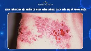 zona thần kinh bội nhiễm