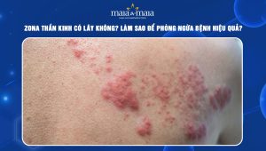 Zona thần kinh có lây không