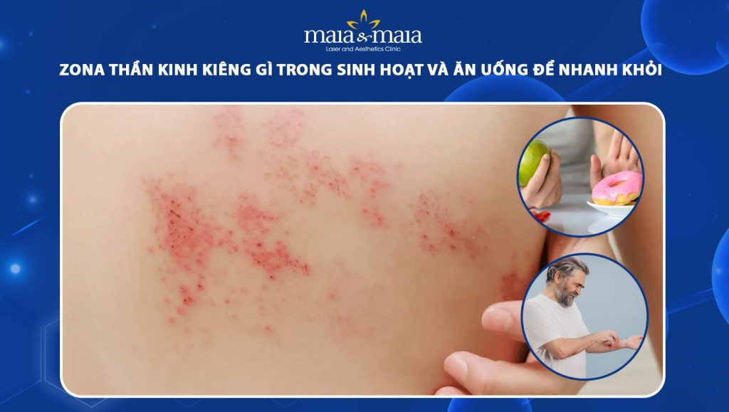 zona thần kinh kiêng gì