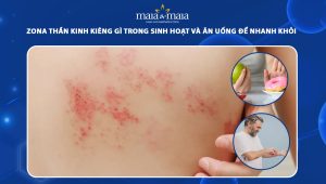 zona thần kinh kiêng gì