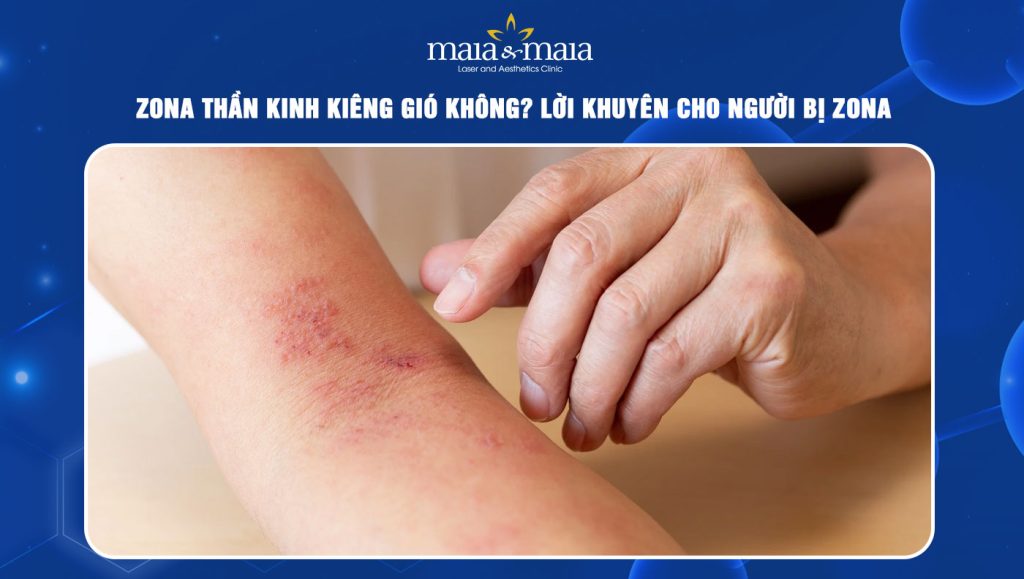 zona thần kinh kiêng gió không