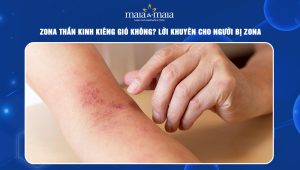 zona thần kinh kiêng gió không