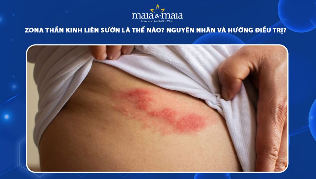 Zona thần kinh liên sườn: Nguyên nhân và hướng điều trị 1 zona thần kinh liên sườn
