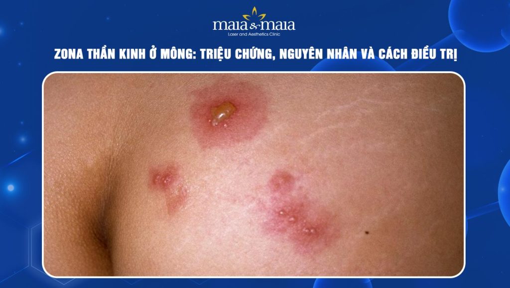 Zona thần kinh ở mông