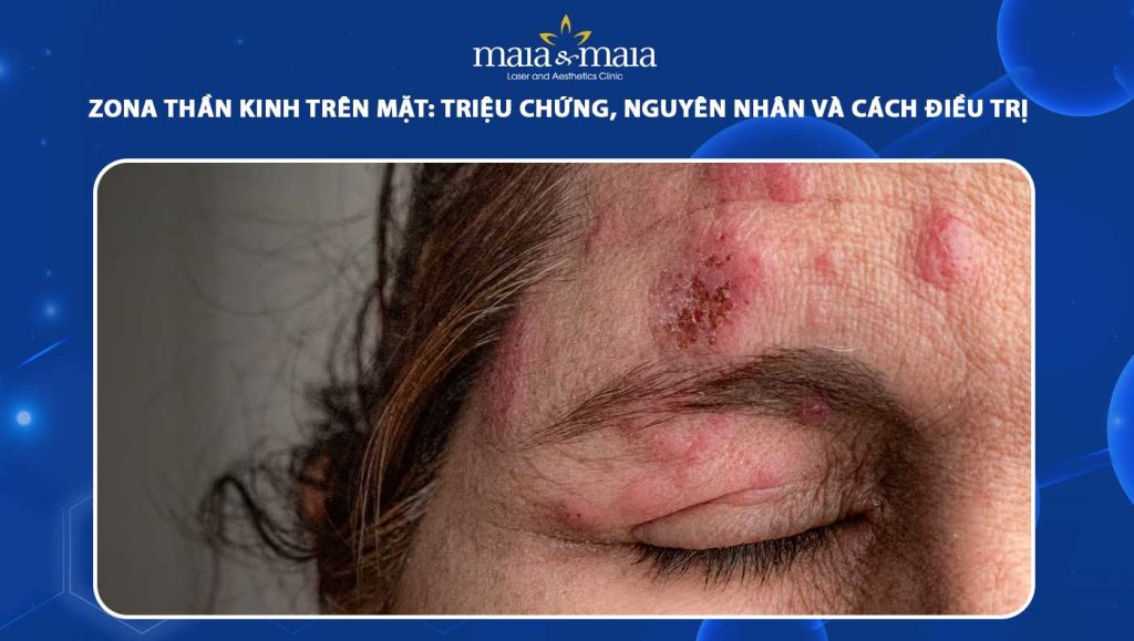 zona thần kinh trên mặt