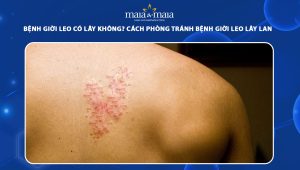 bệnh giời leo có lây không